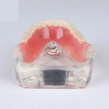 Стоматологическая Модель Обучения Изучению зубов Overdenture Inferior 4 Демонстрационная Модель имплантата